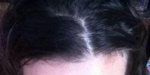 Роаккутан и выпадение волос