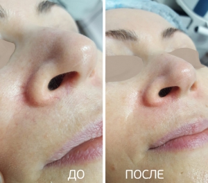 Удаление мелких сосудов (крылья носа). Фото до и сразу после процедуры. Аппарат М22 , врач Дергунова Е.А