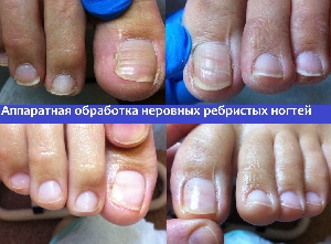 Обработка ногтей с онихогрифозом, фото №7