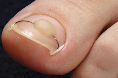Ортониксия - безоперационное лечение вросших ногтей.