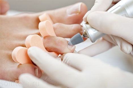 Обработка ногтей с онихогрифозом/онихомикозом